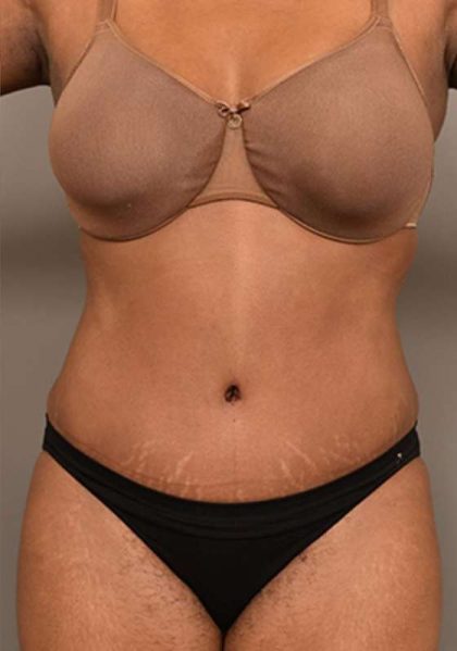 Tummy Tuck Before & After Patient #312