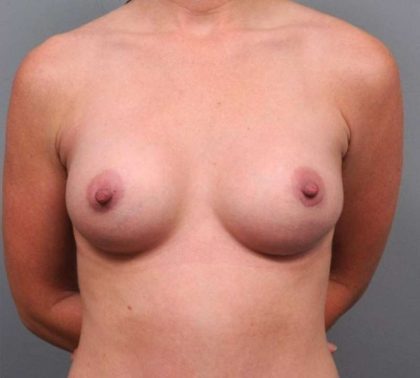 Under The Muscle Breast Augmentation Before & After Patient #1150