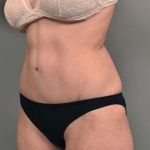 Tummy Tuck Before & After Patient #319