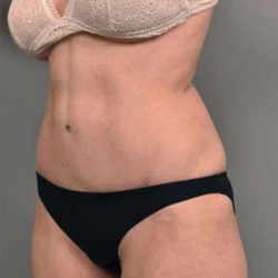 Tummy Tuck Before & After Patient #319
