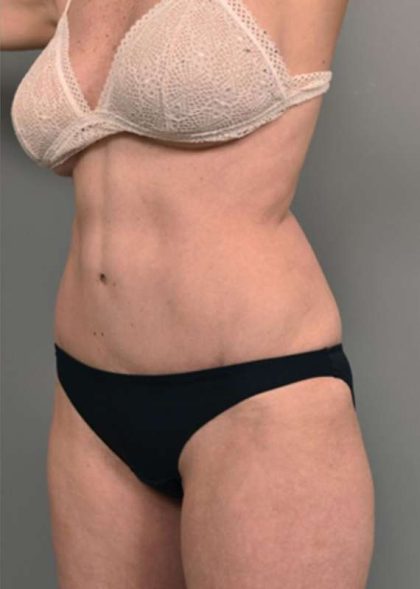 Tummy Tuck Before & After Patient #319