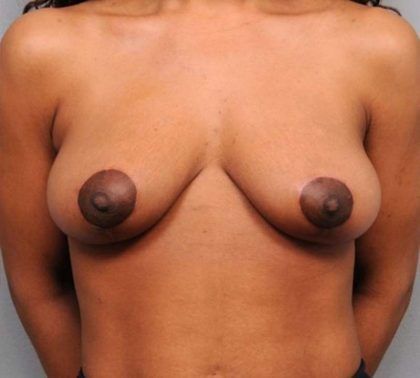 Breast Lift Before & After Patient #1207