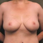 Breast Lift Before & After Patient #1257