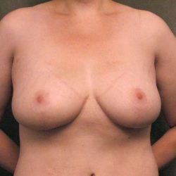 Breast Lift Before & After Patient #1257