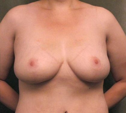 Breast Lift Before & After Patient #1257