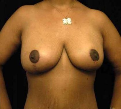 Breast Lift Before & After Patient #1262