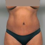 Tummy Tuck Before & After Patient #322