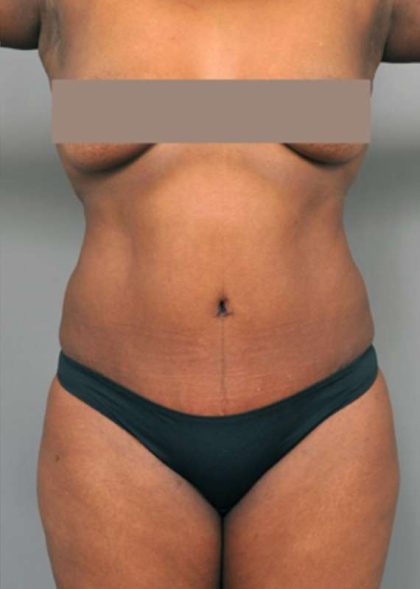 Tummy Tuck Before & After Patient #322