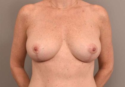 Breast Lift Before & After Patient #1270