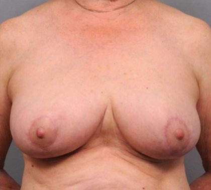 Breast Reduction Before & After Patient #1298