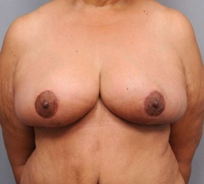 Breast Reduction Before & After Patient #1303