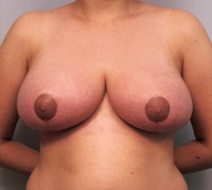 Breast Reduction Before & After Patient #1338