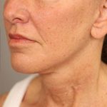 Facelift Before & After Patient #1359