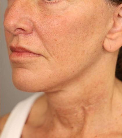 Facelift Before & After Patient #1359