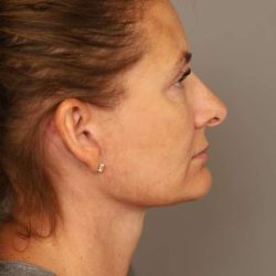 Facelift Before & After Patient #1380