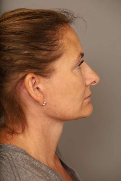 Facelift Before & After Patient #1380