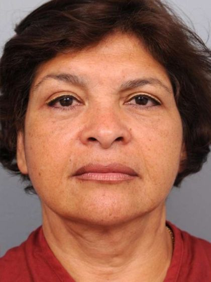 Facelift Before & After Patient #1399