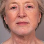 Facelift Before & After Patient #1404