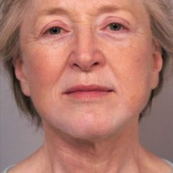Facelift Before & After Patient #1404