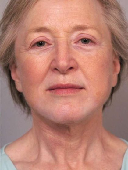 Facelift Before & After Patient #1404