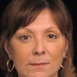 Facelift Before & After Patient #1411
