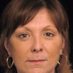 Facelift Before & After Patient #1411