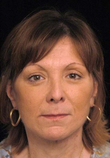 Facelift Before & After Patient #1411