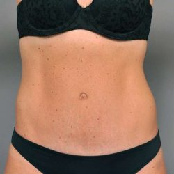Tummy Tuck Before & After Patient #338