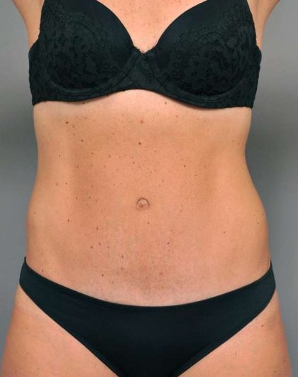 Tummy Tuck Before & After Patient #338
