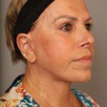 Facelift Before & After Patient #1418