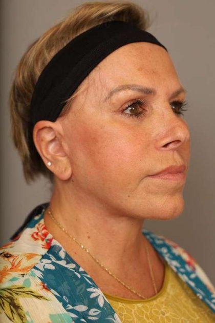 Facelift Before & After Patient #1418