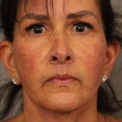 Facelift Before & After Patient #1427