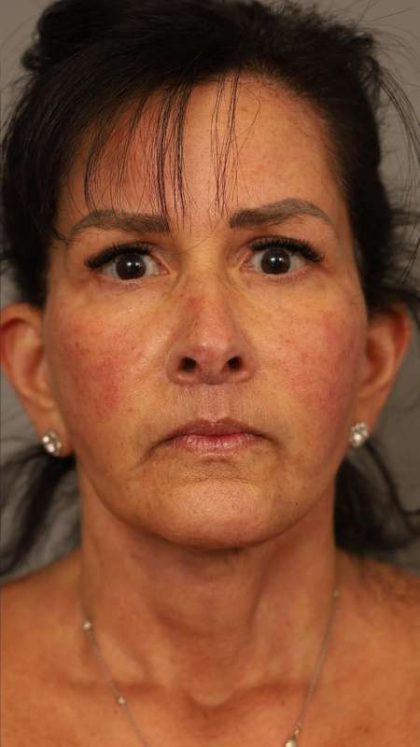 Facelift Before & After Patient #1427