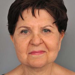 Facelift Before & After Patient #1436