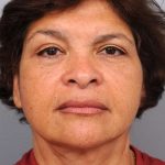 Naturalift&trade; Mini Facelift Before & After Patient #1452