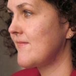 Naturalift&trade; Mini Facelift Before & After Patient #1457