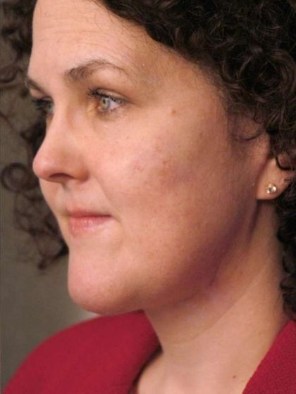 Naturalift™ Mini Facelift Before & After Patient #1457