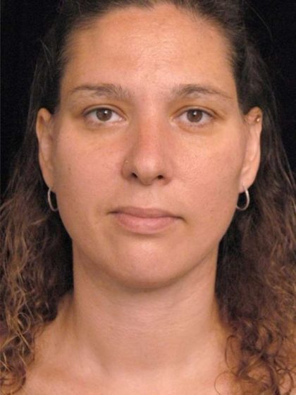 Naturalift™ Mini Facelift Before & After Patient #1464