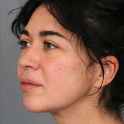 Naturalift™ Mini Facelift Before & After Patient #1474