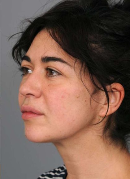 Naturalift™ Mini Facelift Before & After Patient #1474