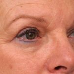 Eyelid Surgery Before & After Patient #1481