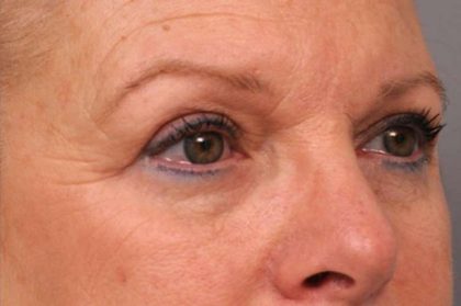 Eyelid Surgery Before & After Patient #1481