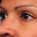 Eyelid Surgery Before & After Patient #1490