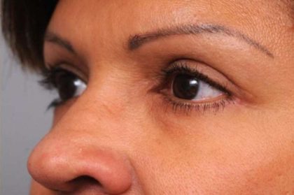 Eyelid Surgery Before & After Patient #1490
