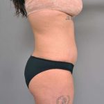 Tummy Tuck Before & After Patient #345