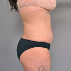 Tummy Tuck Before & After Patient #345
