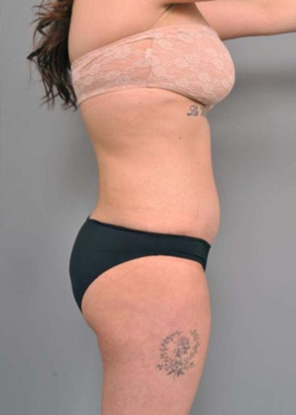 Tummy Tuck Before & After Patient #345