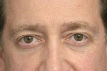 Eyelid Surgery Before & After Patient #1495