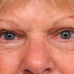 Eyelid Surgery Before & After Patient #1504