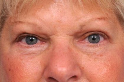 Eyelid Surgery Before & After Patient #1504
